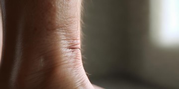 小腿划伤缝针，物业会赔付吗？
